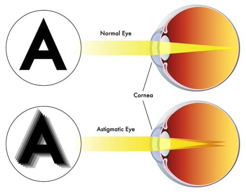Illustration de l’astigmatisme