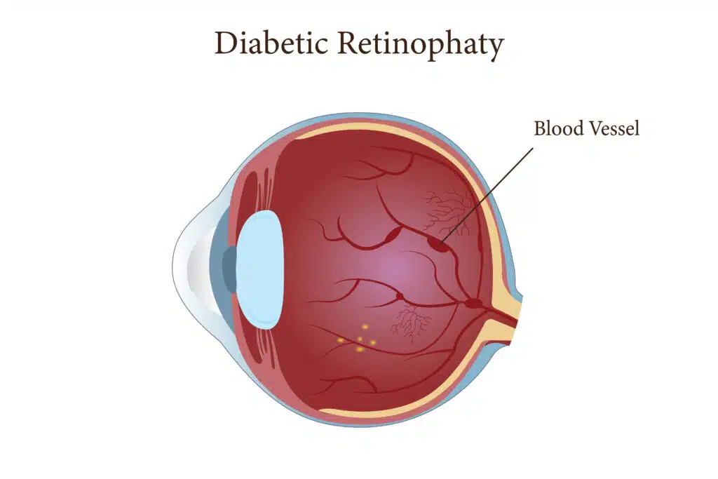 Rétinopathie diabétique