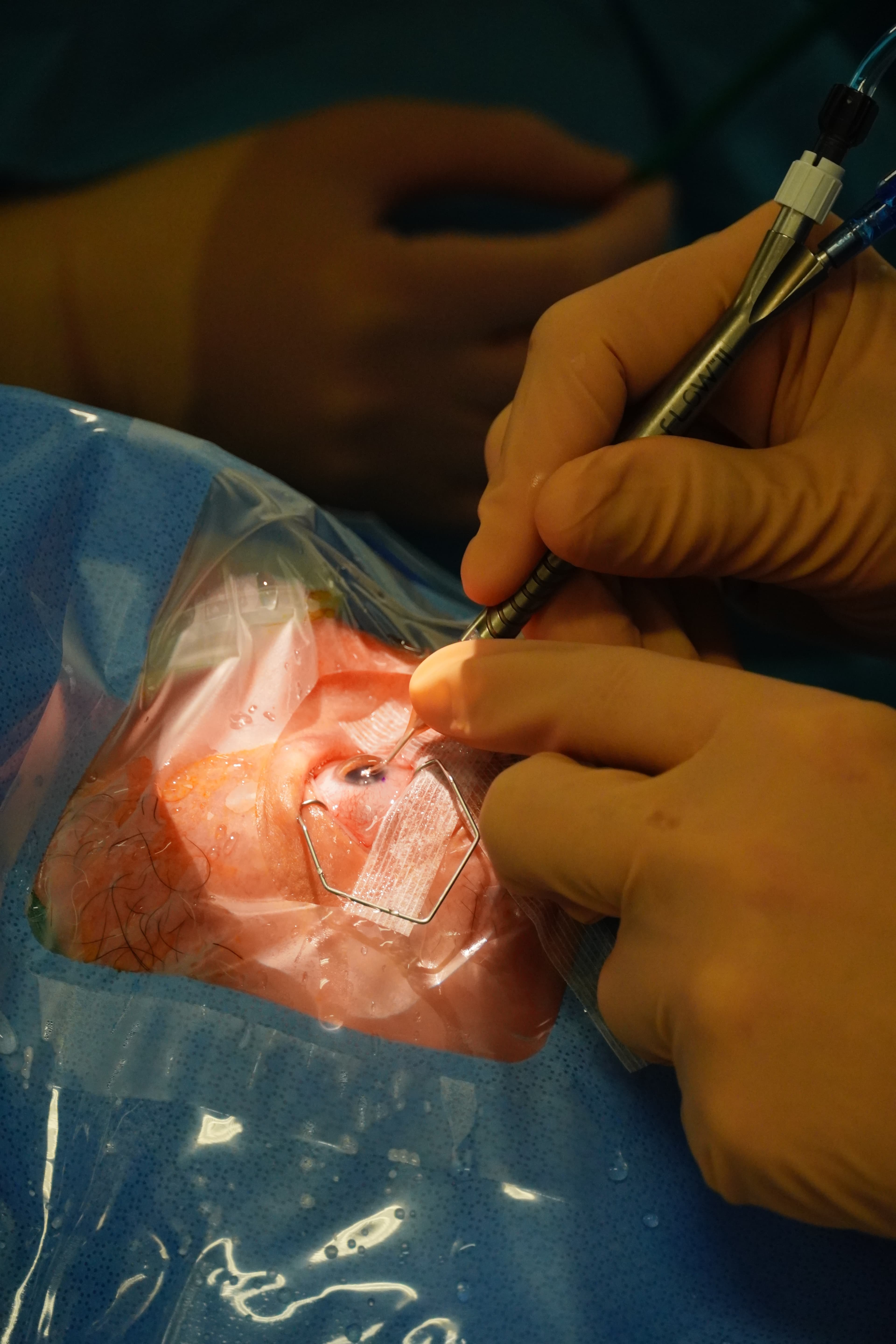 Déroulé de la chirurgie de la cataracte