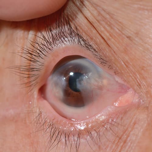 Chirurgie du glaucome