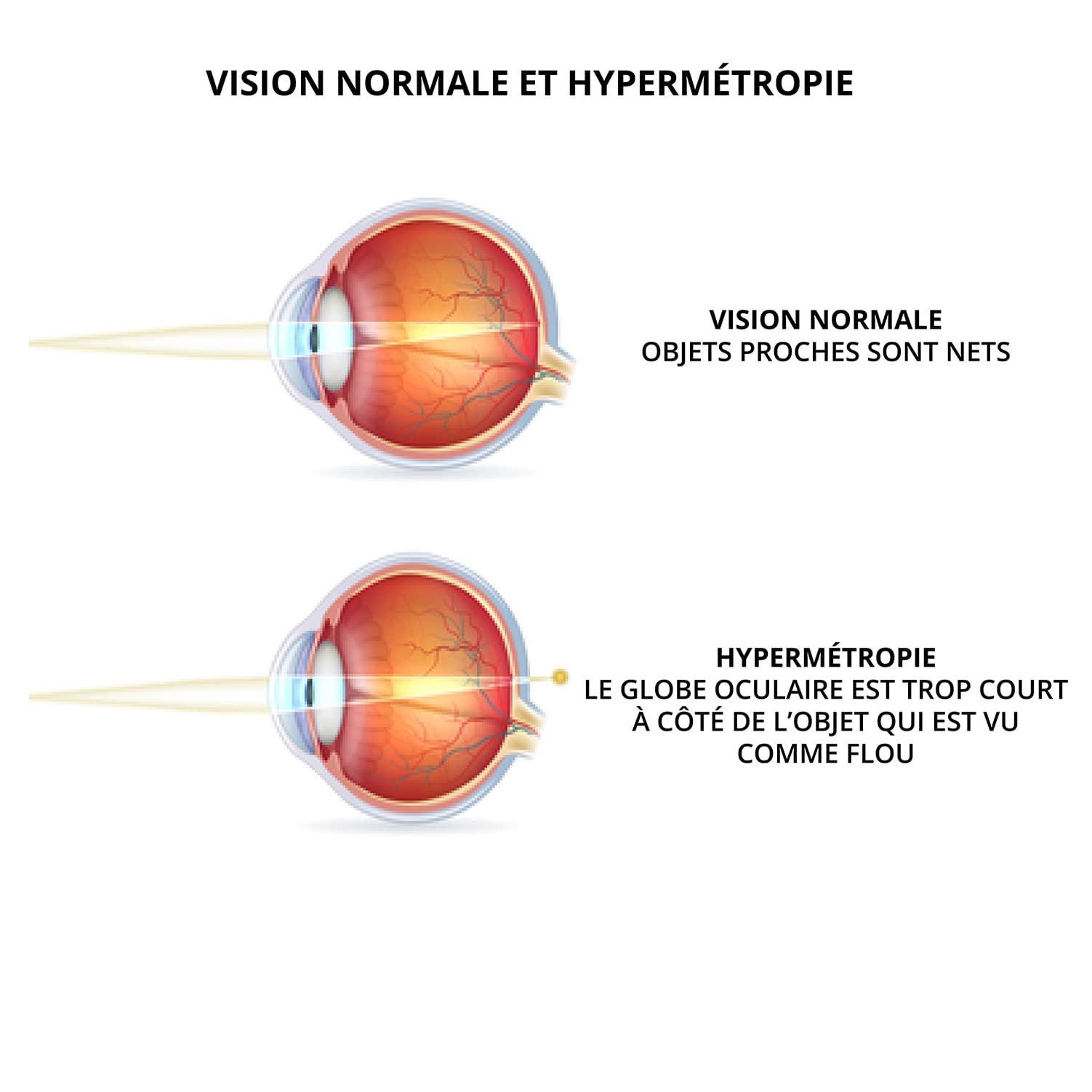 Illustration de l’hypermétropie