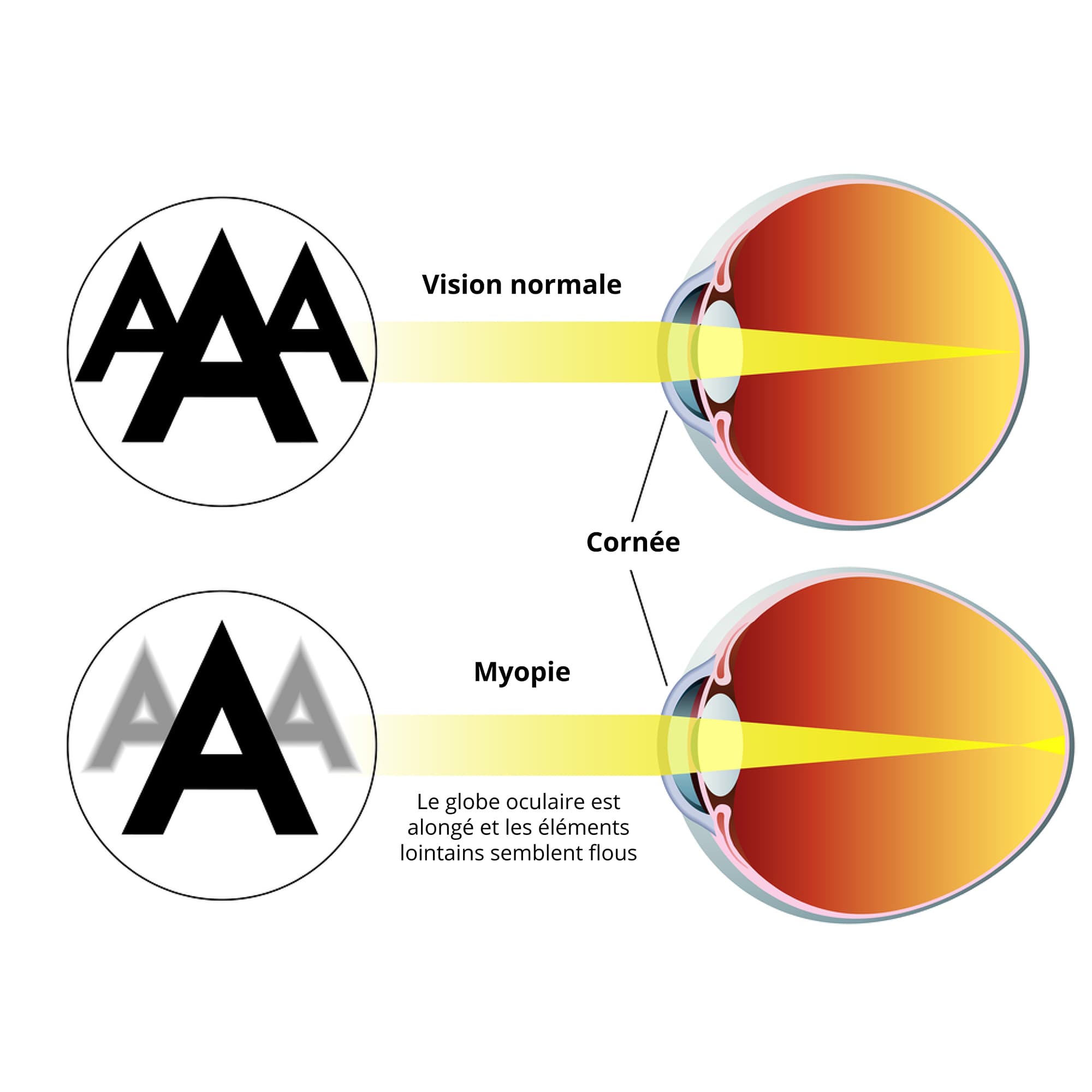 Illustration de la myopie