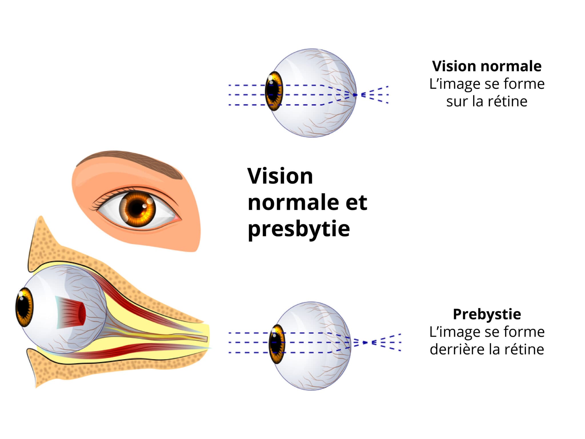 Illustration de la presbytie